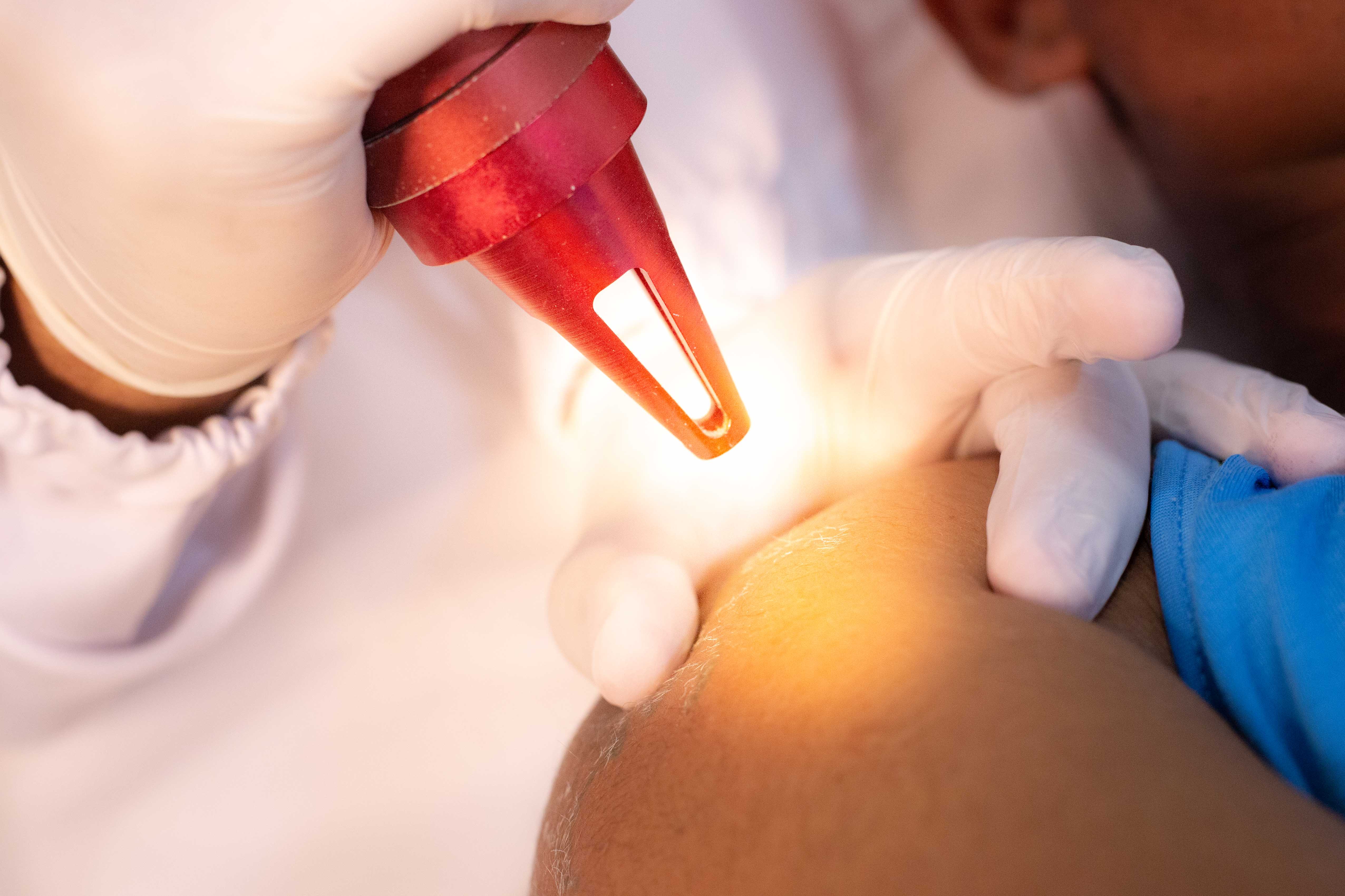 Detalhe de um procedimento de remoção a laser realizado pelo Dr. Paulo Sérgio